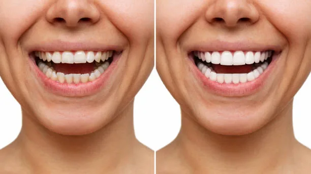 a comparison of the before and after of a person's teeth with veneers
