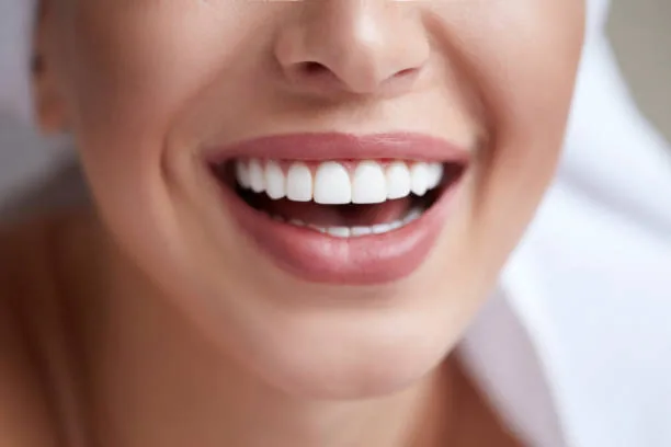 an image of a woman smiling widely, showing her veneers