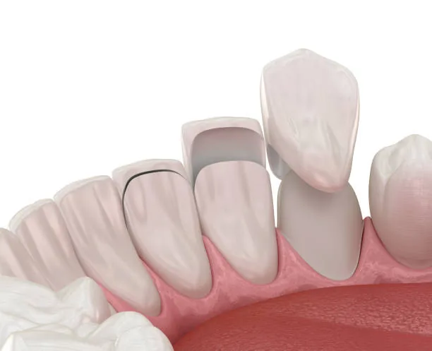 a digital image showing how veneers are attached to the teeth