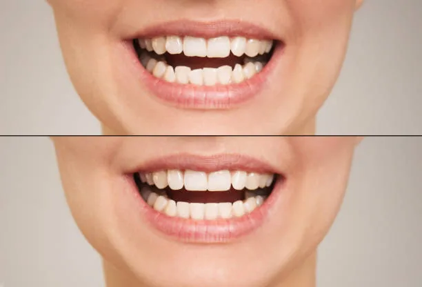 a before and after photos of teeth with veneers