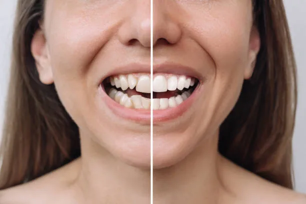 veneers before and after comparison