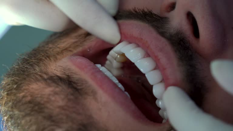 close-up shot of a person's teeth during veneers installation