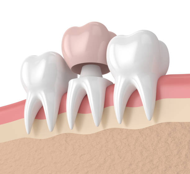 image showing a dental crown