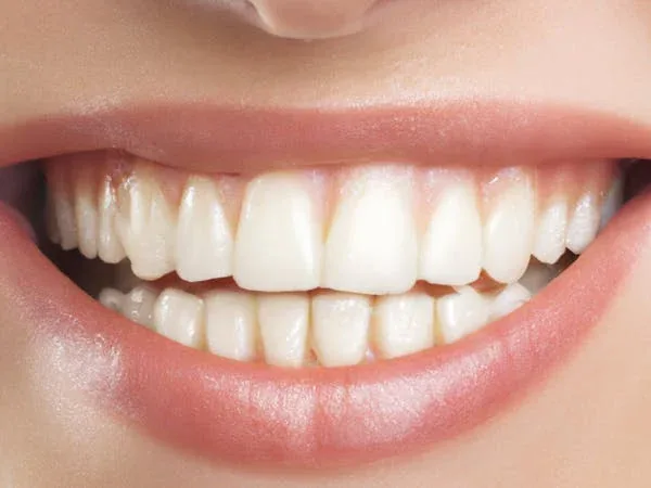 a close-up shot of a woman smiling showing her veneers