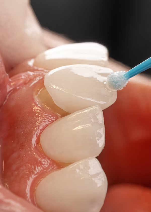 a photo showing how veneers are installed